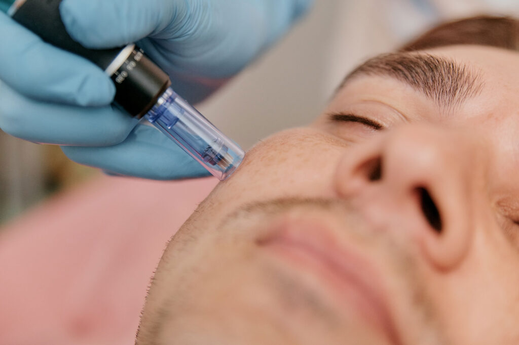 Microneedling